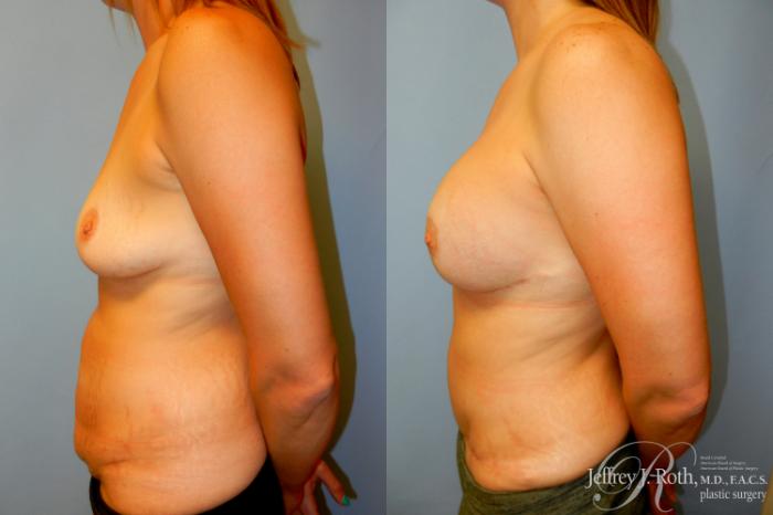 Before & After Liposuction Case 259 Left Side View in Las Vegas and Henderson, NV