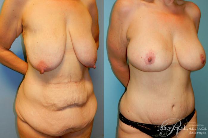 Before & After Mommy Makeover Case 270 Right Oblique View in Las Vegas and Henderson, NV