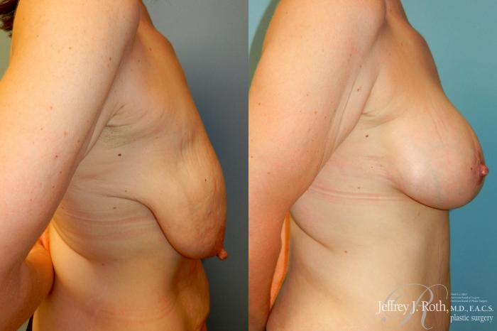 Before & After Mommy Makeover Case 270 Right Side View in Las Vegas and Henderson, NV