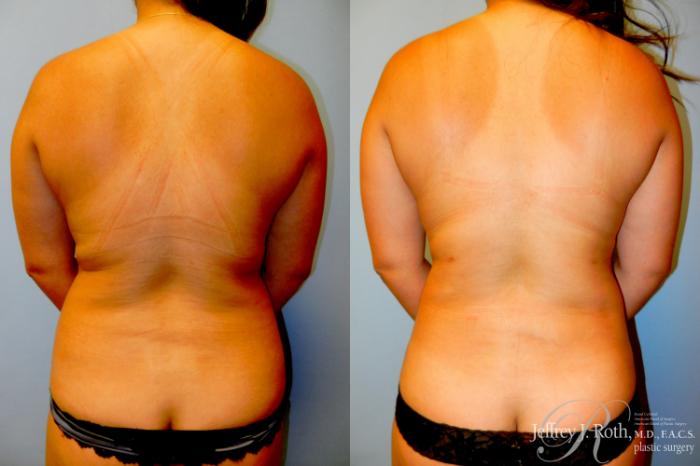 Before & After Mommy Makeover Case 307 Back View in Las Vegas and Henderson, NV