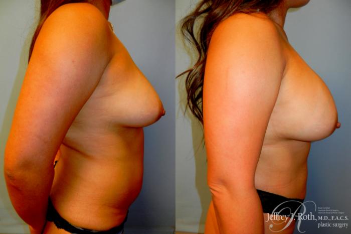 Before & After Mommy Makeover Case 307 Right Side View in Las Vegas and Henderson, NV