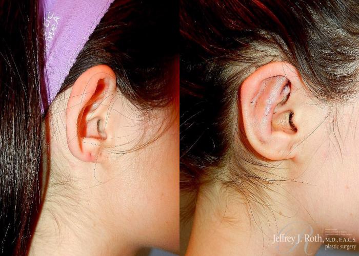 Before & After Otoplasty Case 113 View #3 View in Las Vegas, NV