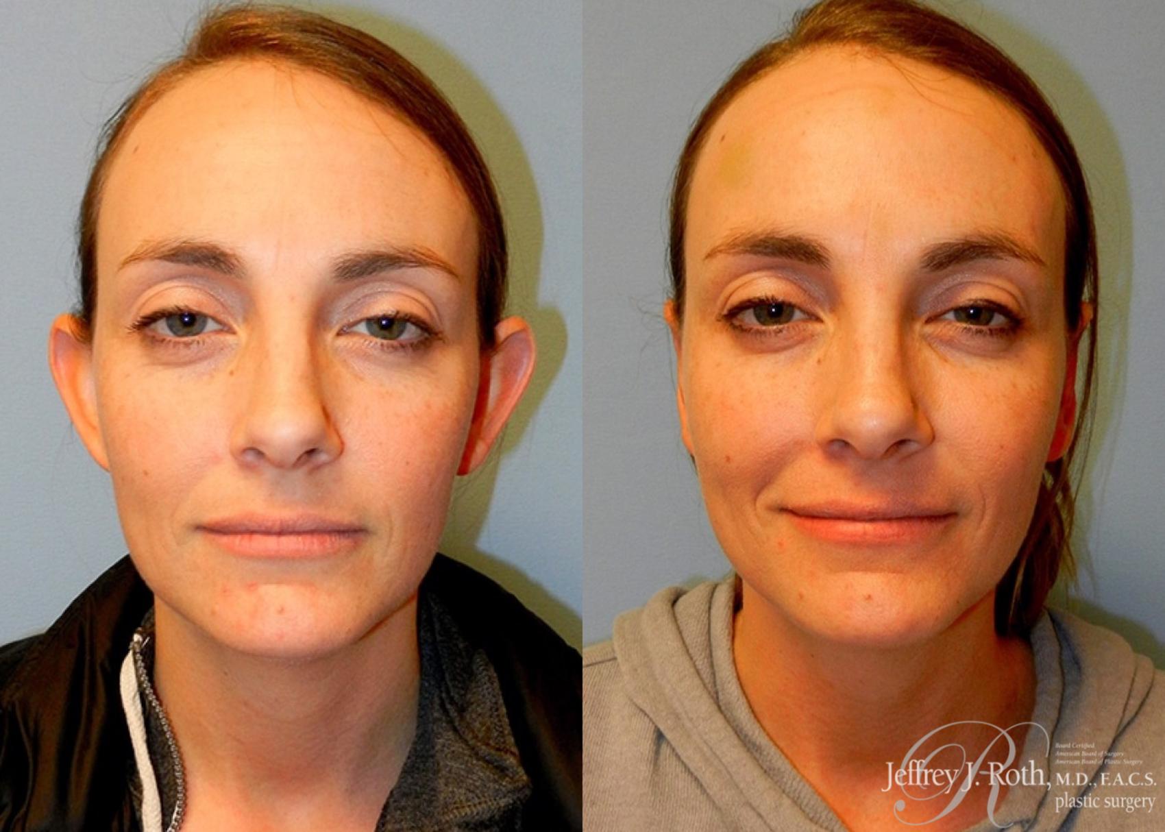 Before & After Otoplasty Case 114 View #1 View in Las Vegas, NV