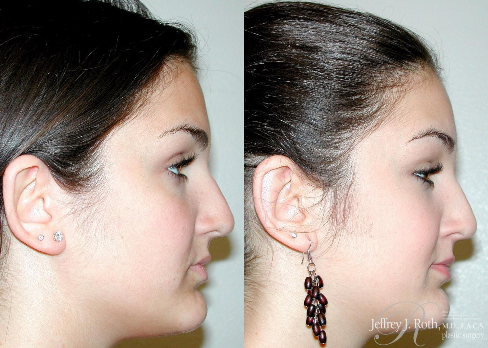 Before & After Otoplasty Case 116 View #2 View in Las Vegas, NV