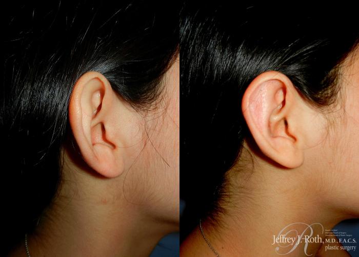 Before & After Otoplasty Case 117 Left Side View in Las Vegas and Henderson, NV