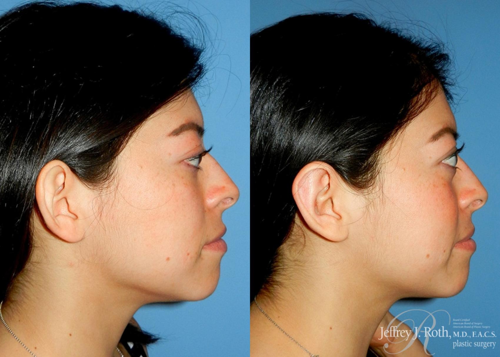 Before & After Otoplasty Case 117 Right Side View in Las Vegas, NV