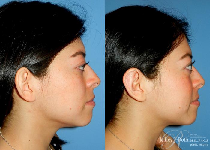 Before & After Otoplasty Case 117 Right Side View in Las Vegas and Henderson, NV