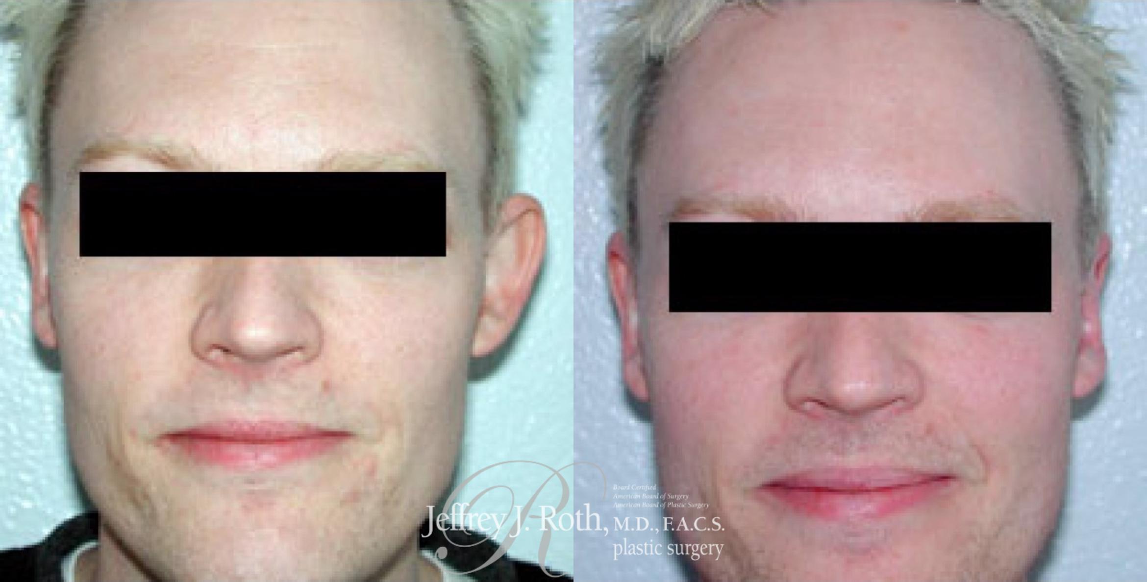 Before & After Otoplasty for Men Case 167 View #1 View in Las Vegas, NV