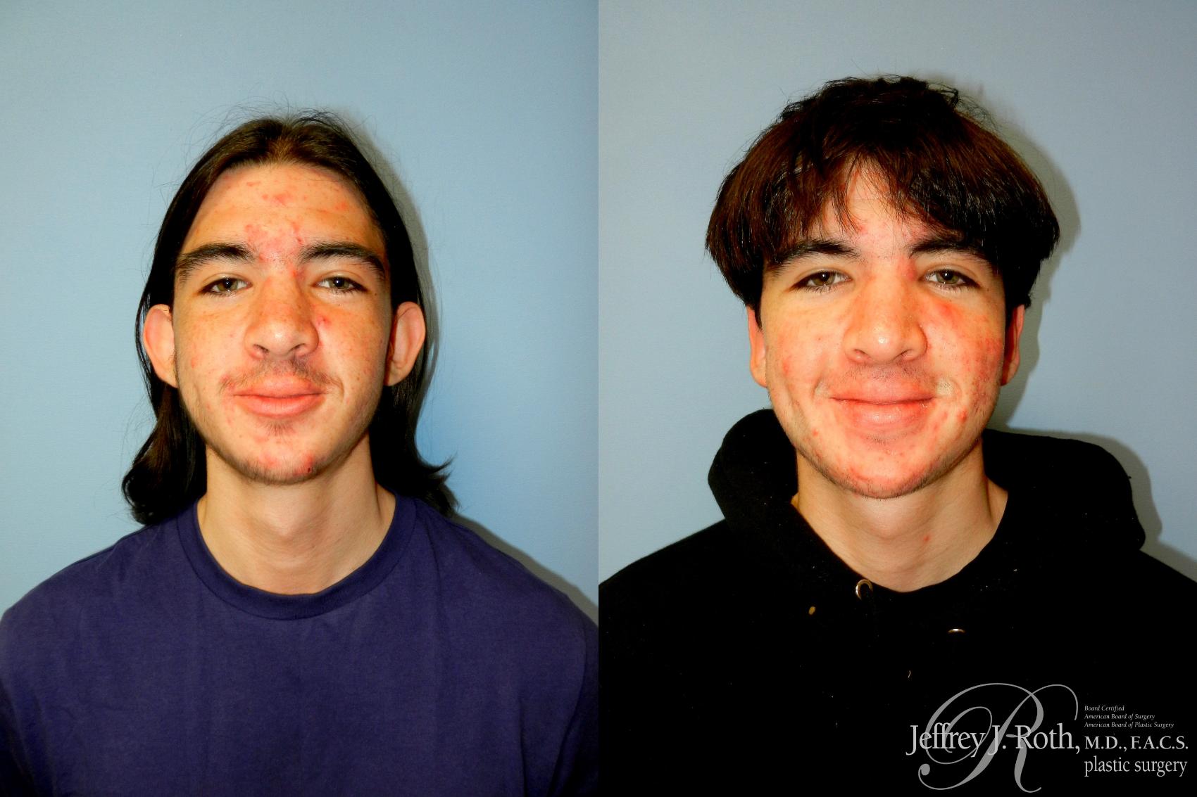 Before & After Otoplasty Case 291 Front View in Las Vegas and Henderson, NV
