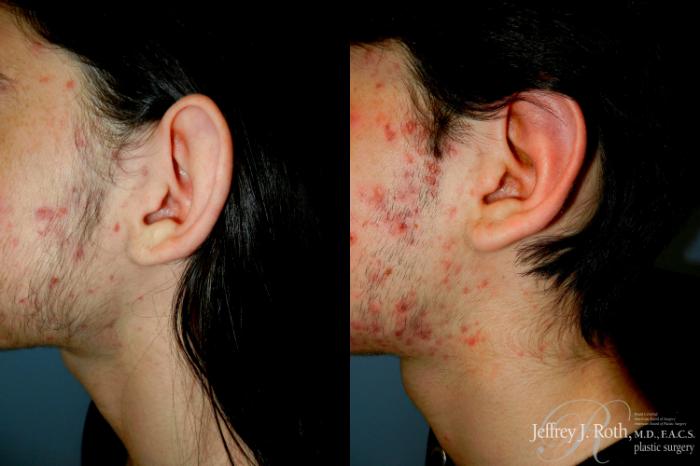 Before & After Otoplasty Case 291 Left Side Close Up View in Las Vegas and Henderson, NV