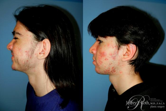 Before & After Otoplasty Case 291 Left Side View in Las Vegas and Henderson, NV