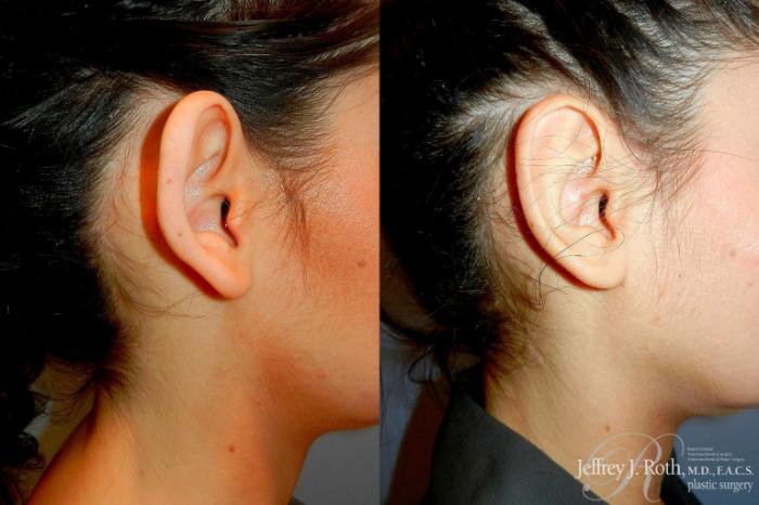 Before & After Otoplasty Case 299 Right Side View in Las Vegas and Henderson, NV