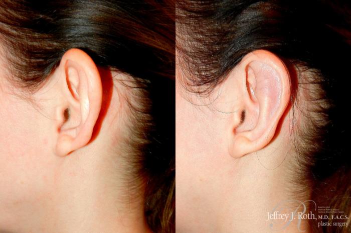 Before & After Otoplasty Case 305 Left Side View in Las Vegas and Henderson, NV