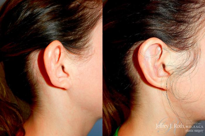 Before & After Otoplasty Case 305 Right Side View in Las Vegas and Henderson, NV