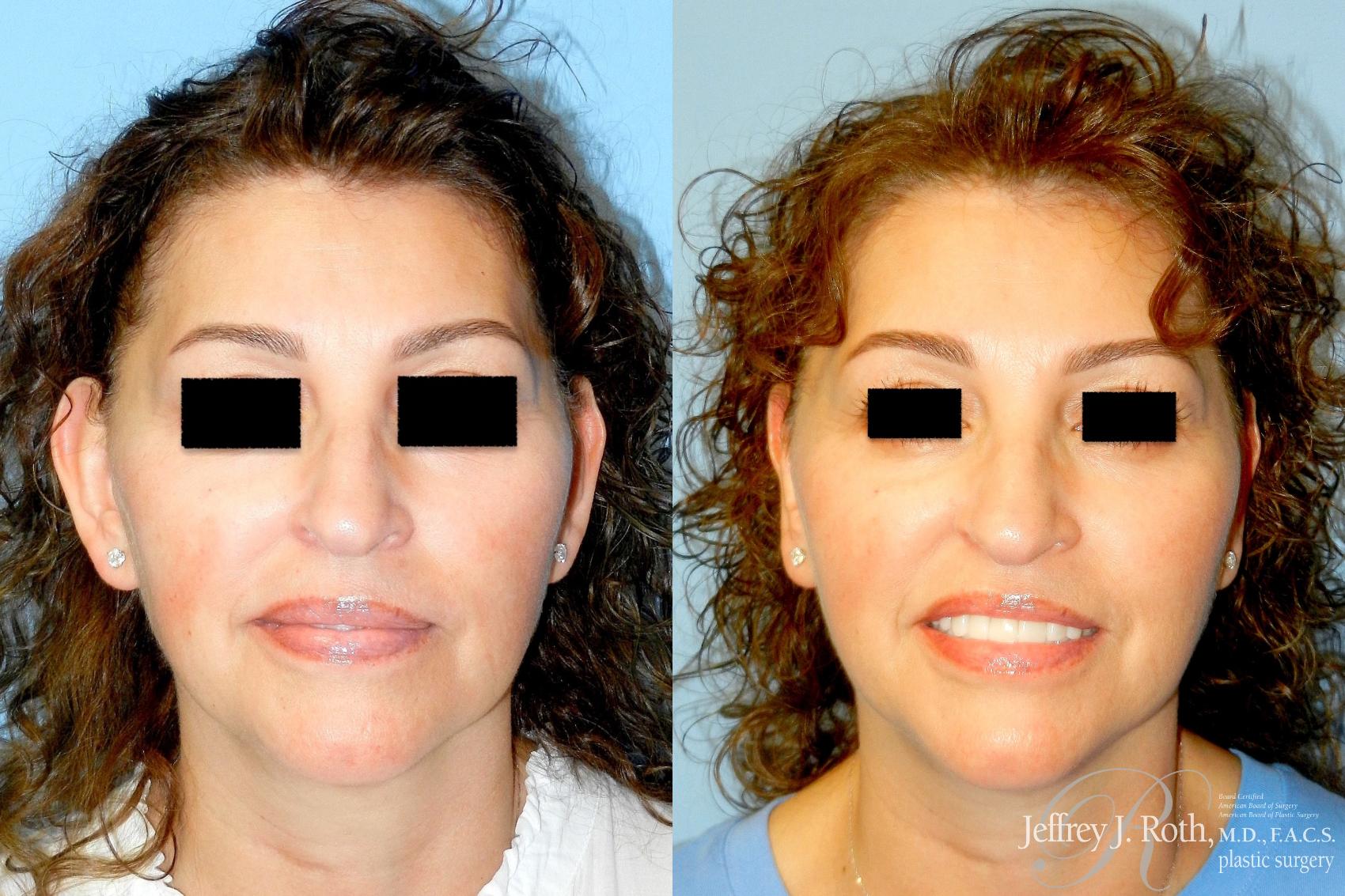 Before & After Otoplasty Case 343 Front View in Las Vegas and Henderson, NV