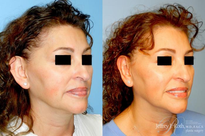Before & After Otoplasty Case 343 Right Oblique View in Las Vegas and Henderson, NV