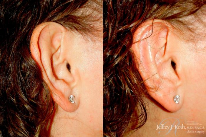 Before & After Otoplasty Case 343 Right Side View in Las Vegas and Henderson, NV