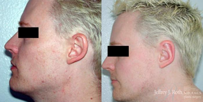 Before & After Otoplasty for Men Case 167 View #2 View in Las Vegas and Henderson, NV