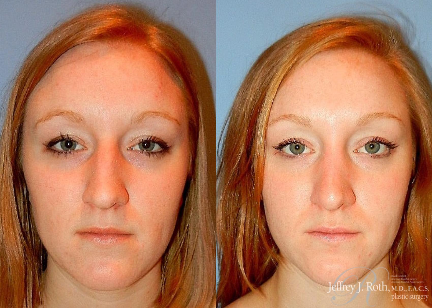 Before & After Rhinoplasty Case 159 View #2 View in Las Vegas, NV
