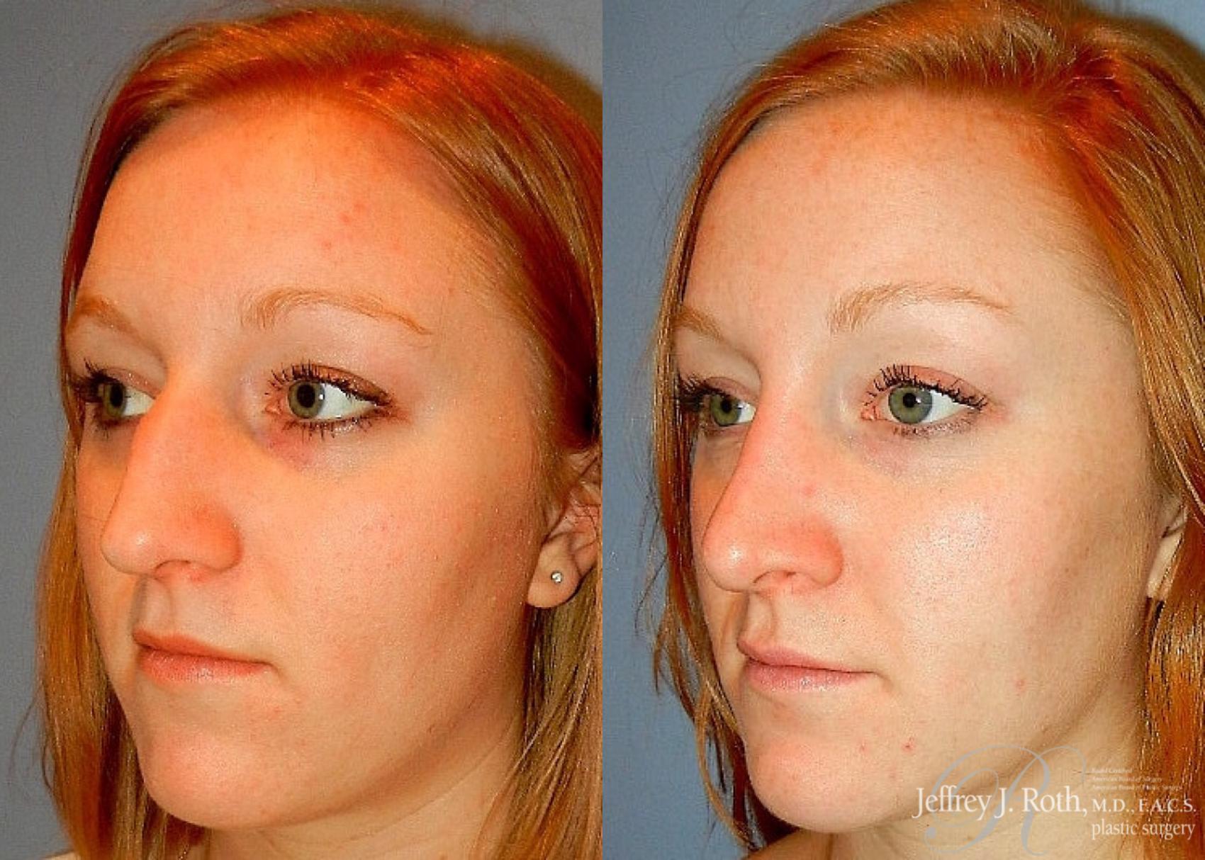 Before & After Rhinoplasty Case 159 View #3 View in Las Vegas, NV
