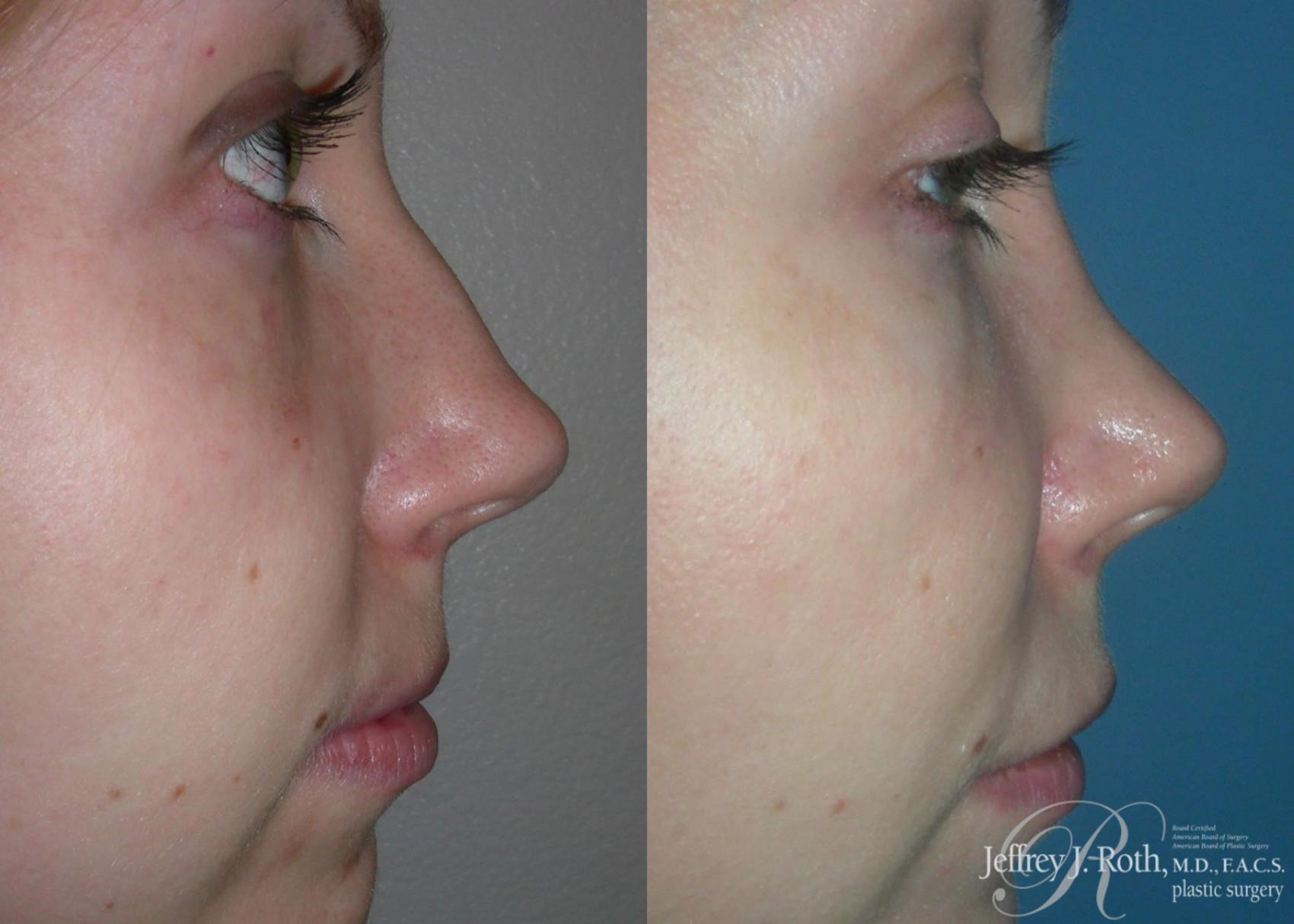 Before & After Rhinoplasty Case 160 View #1 View in Las Vegas, NV