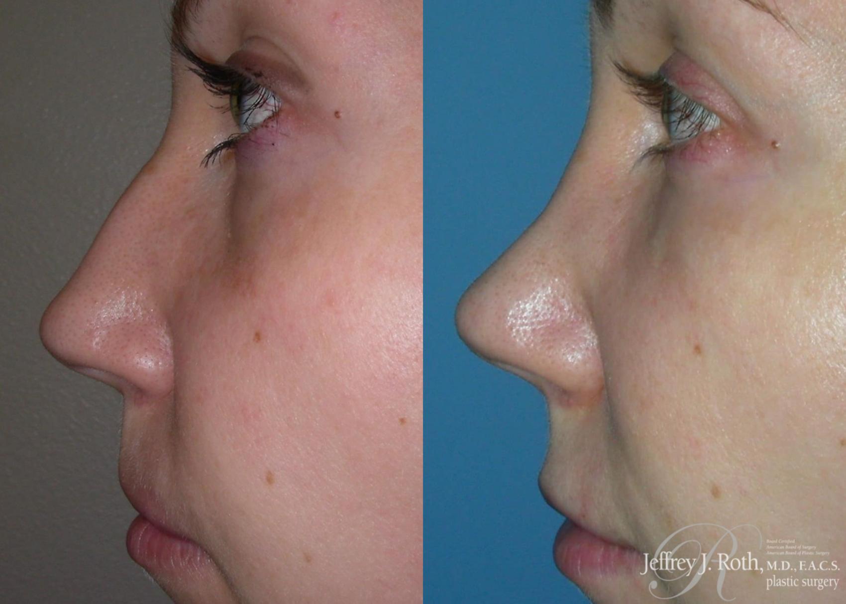 Before & After Rhinoplasty Case 160 View #2 View in Las Vegas, NV
