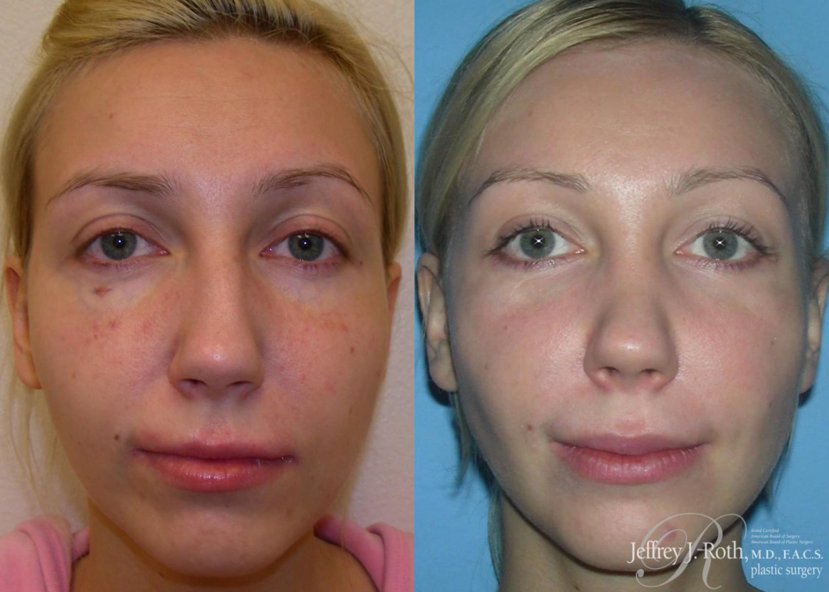 Before & After Rhinoplasty Case 160 View #3 View in Las Vegas, NV