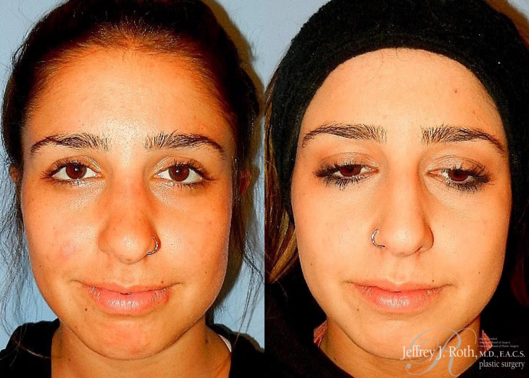 Before & After Rhinoplasty Case 161 View #2 View in Las Vegas, NV