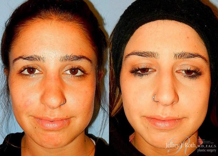 Before & After Rhinoplasty Case 161 View #2 View in Las Vegas and Henderson, NV