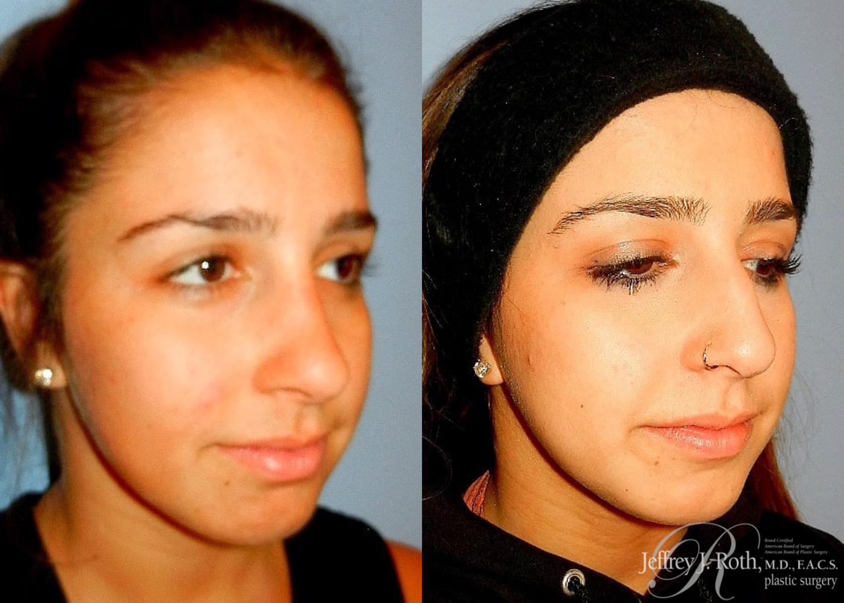 Before & After Rhinoplasty Case 161 View #3 View in Las Vegas, NV