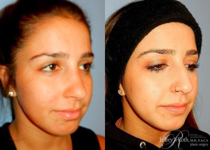 Before & After Rhinoplasty Case 161 View #3 View in Las Vegas and Henderson, NV