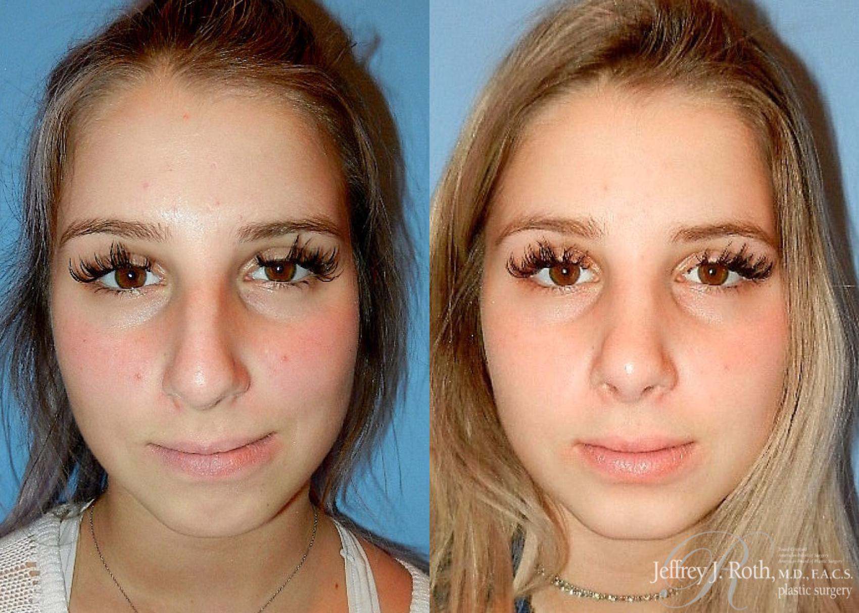 Before & After Rhinoplasty Case 162 View #2 View in Las Vegas and Henderson, NV