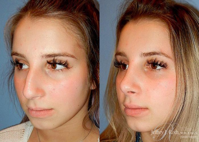 Before & After Rhinoplasty Case 162 View #3 View in Las Vegas, NV