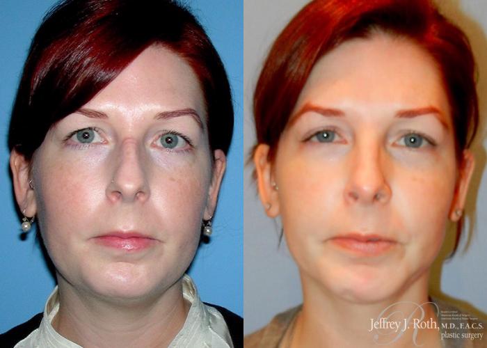 Before & After Rhinoplasty Case 163 View #2 View in Las Vegas, NV