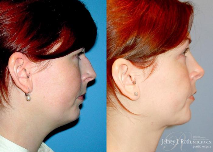 Before & After Rhinoplasty Case 163 View #3 View in Las Vegas, NV
