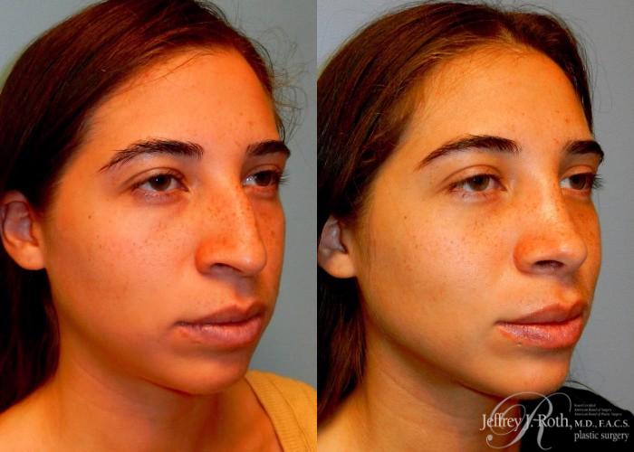 Before & After Rhinoplasty Case 164 View #2 View in Las Vegas and Henderson, NV