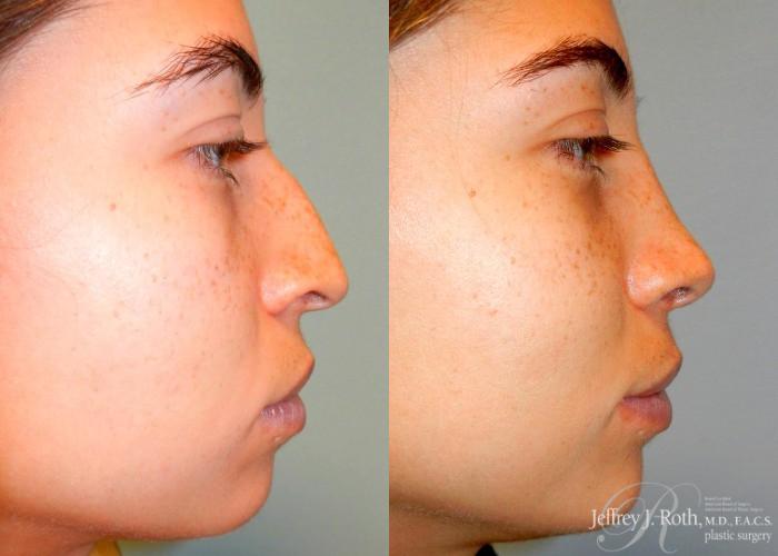 Before & After Rhinoplasty Case 164 View #3 View in Las Vegas and Henderson, NV