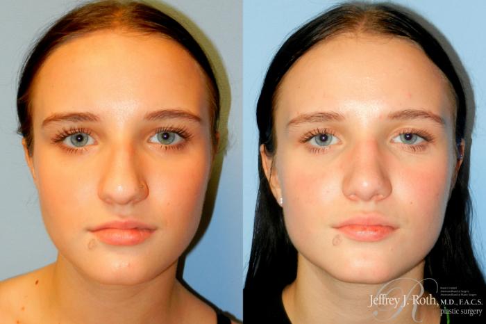 Before & After Rhinoplasty Case 252 Front View in Las Vegas and Henderson, NV