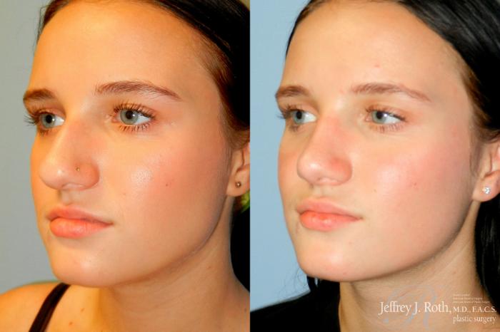 Before & After Rhinoplasty Case 252 Left Oblique View in Las Vegas and Henderson, NV