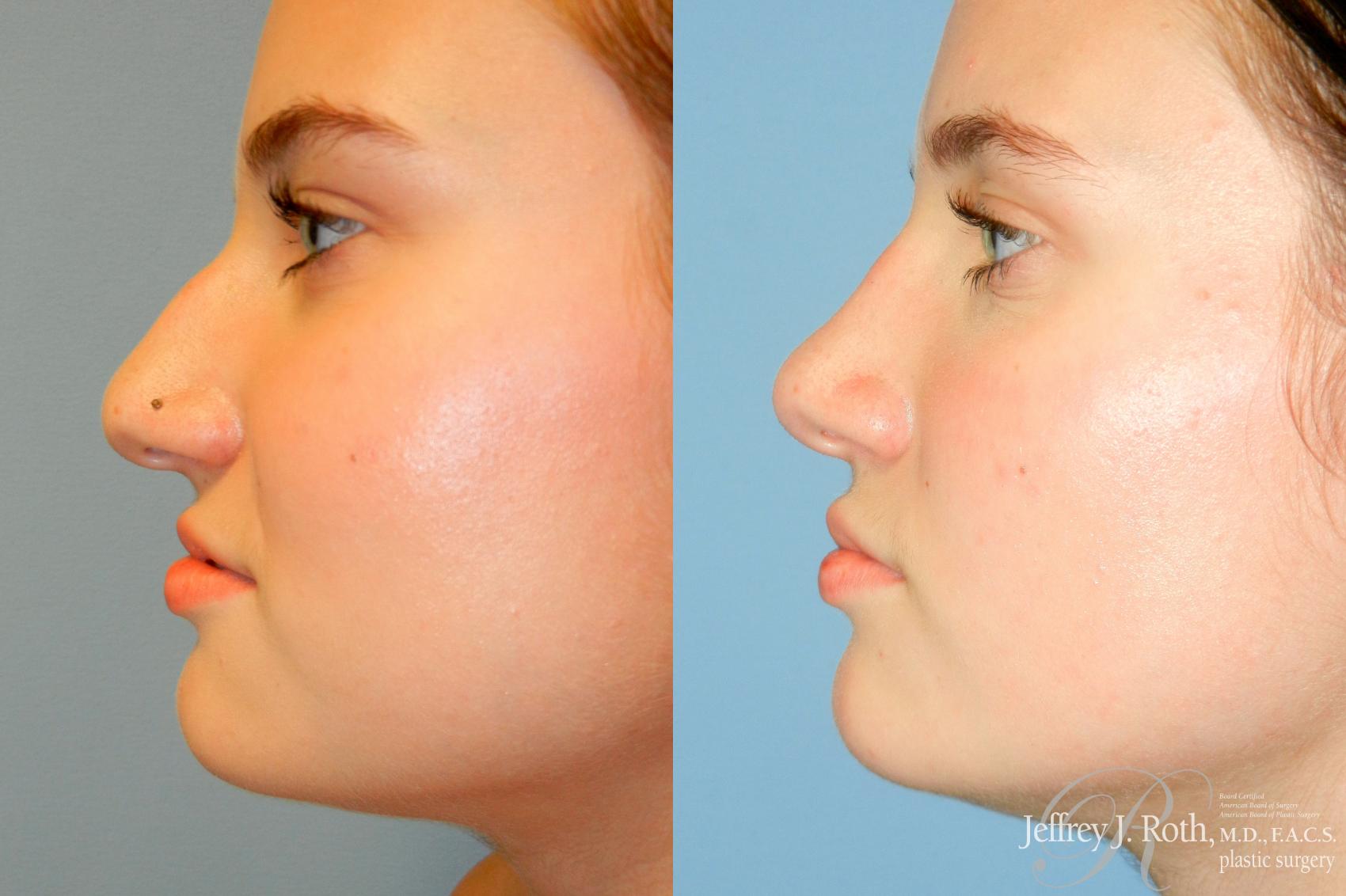 Before & After Rhinoplasty Case 252 Left Side View in Las Vegas, NV