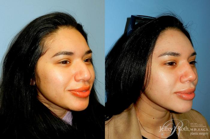 Before & After Rhinoplasty Case 311 Right Oblique View in Las Vegas and Henderson, NV