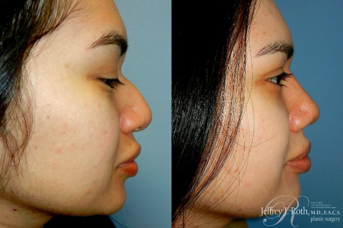 Before & After Rhinoplasty Case 311 Right Side View in Las Vegas and Henderson, NV