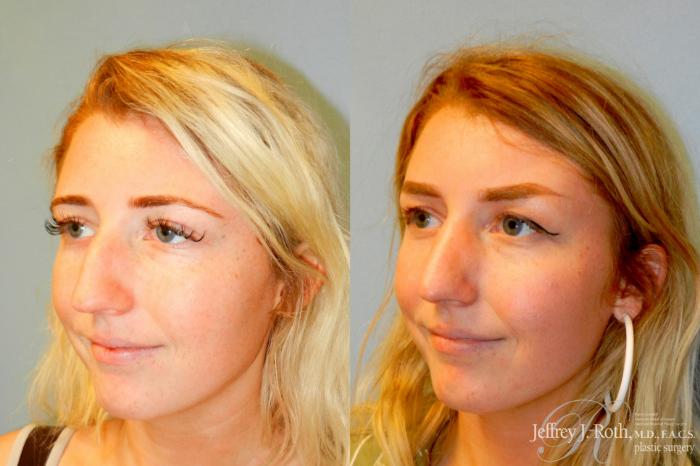 Before & After Rhinoplasty Case 329 Left Oblique View in Las Vegas and Henderson, NV