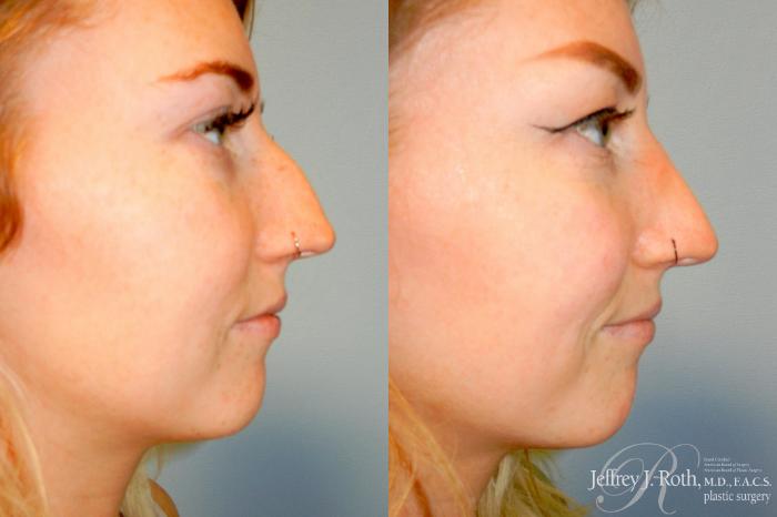 Before & After Rhinoplasty Case 329 Right Side View in Las Vegas and Henderson, NV