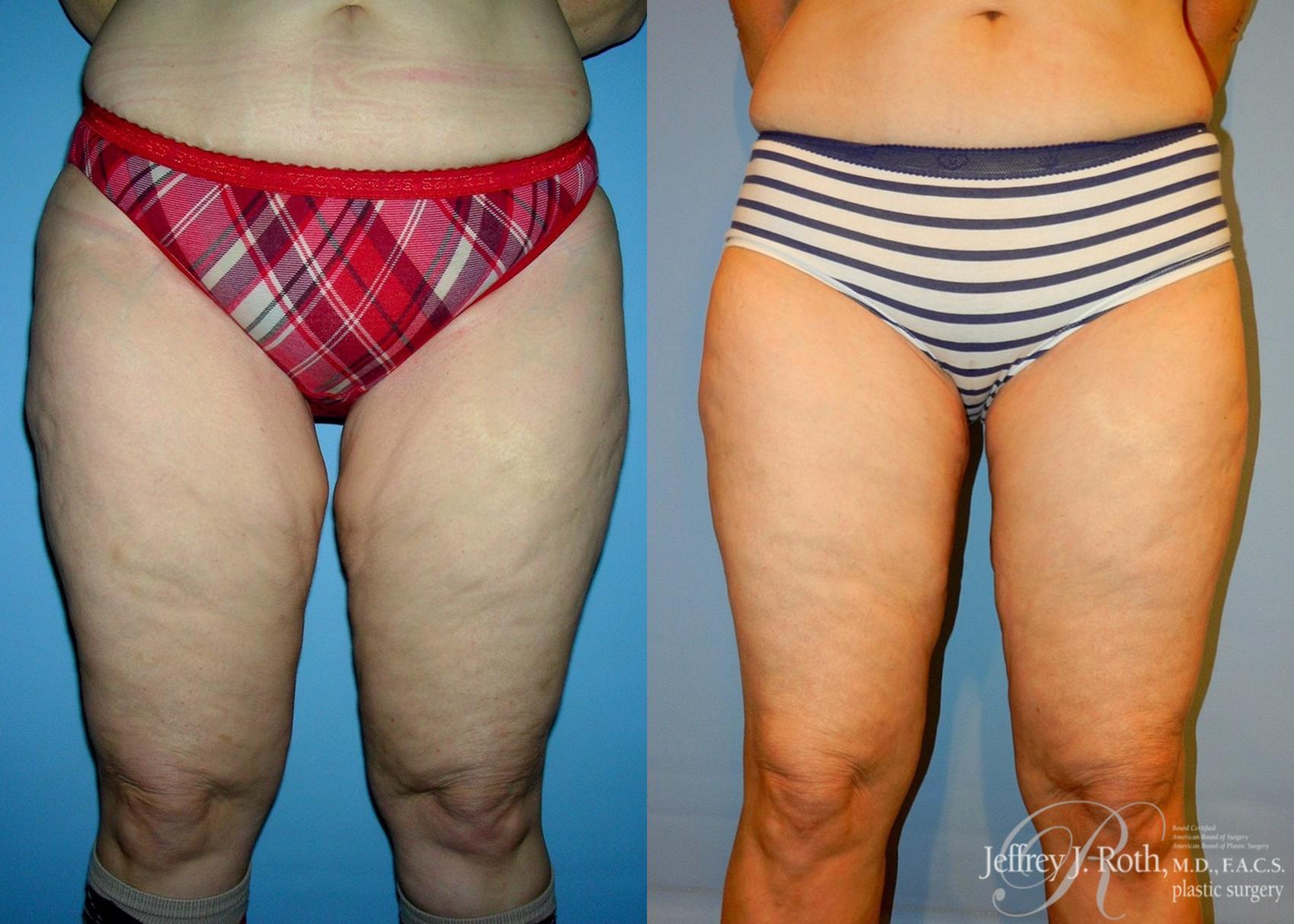 Before & After Thigh Lift Case 23 View #1 View in Las Vegas, NV