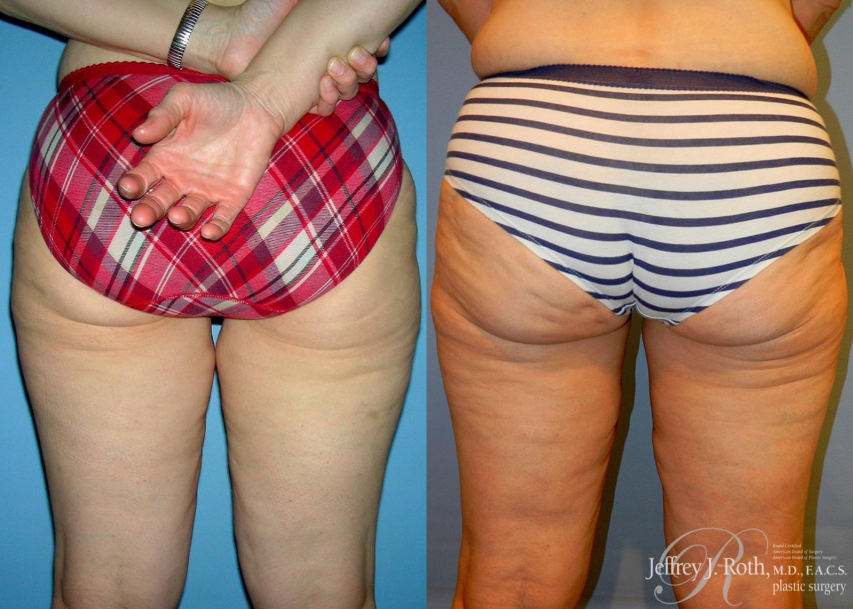 Before & After Thigh Lift Case 23 View #2 View in Las Vegas, NV