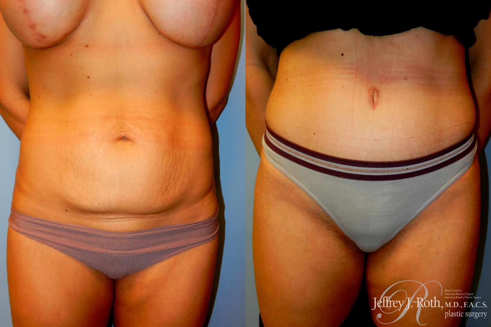 Before & After Tummy Tuck Case 223 Front View in Las Vegas, NV