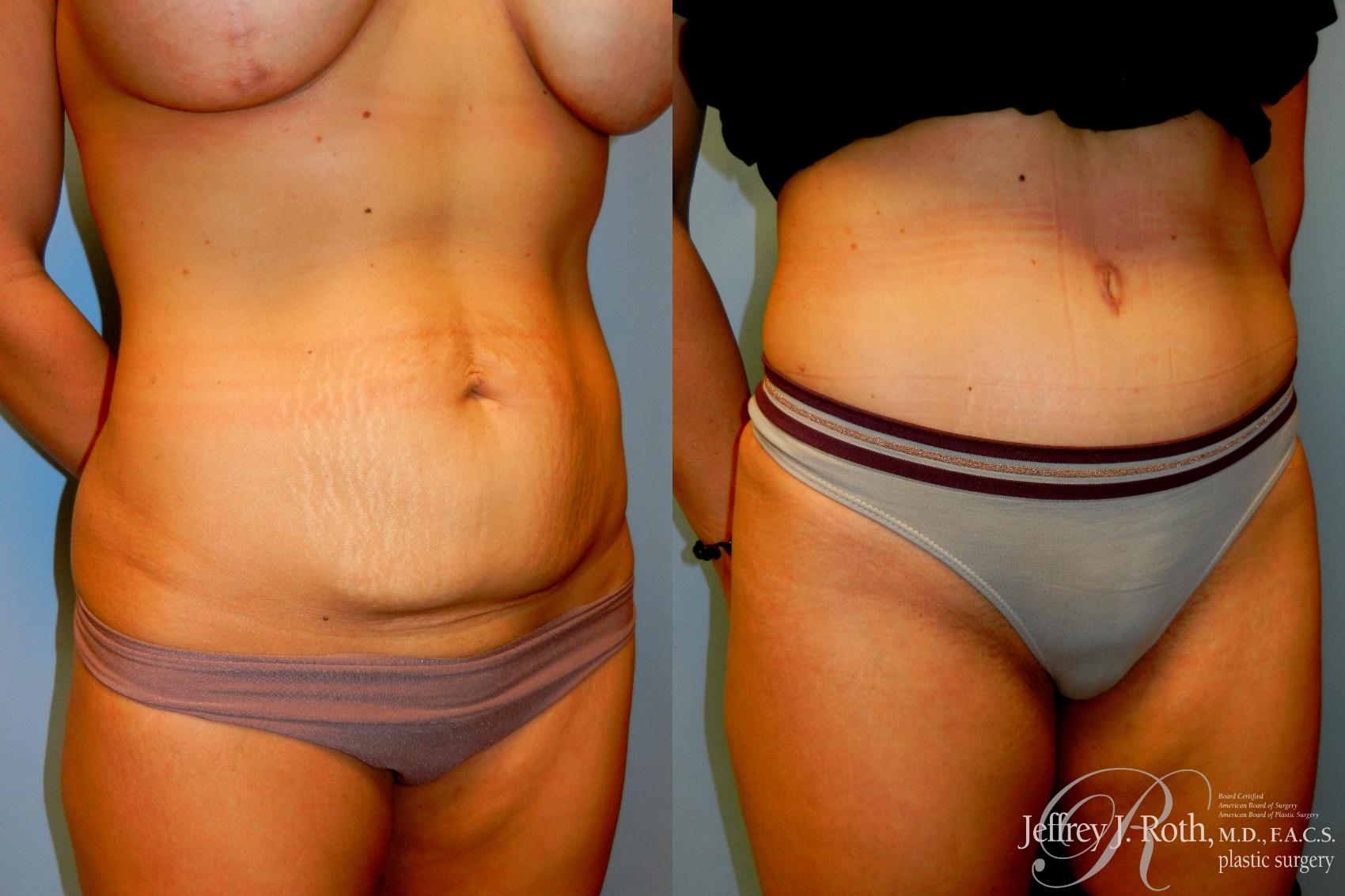 Before & After Tummy Tuck Case 223 Right Oblique View in Las Vegas, NV