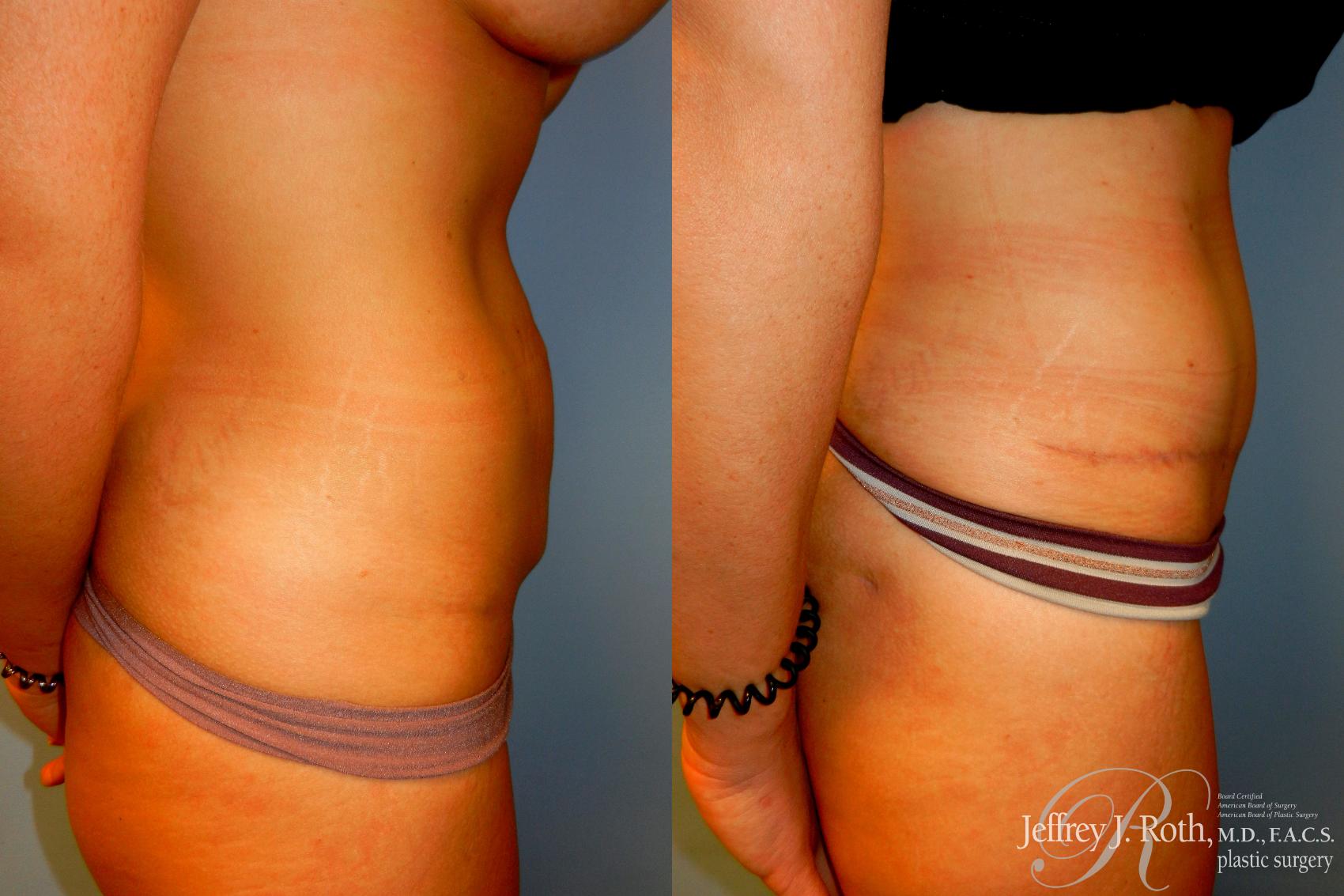 Before & After Tummy Tuck Case 223 Right Side View in Las Vegas, NV
