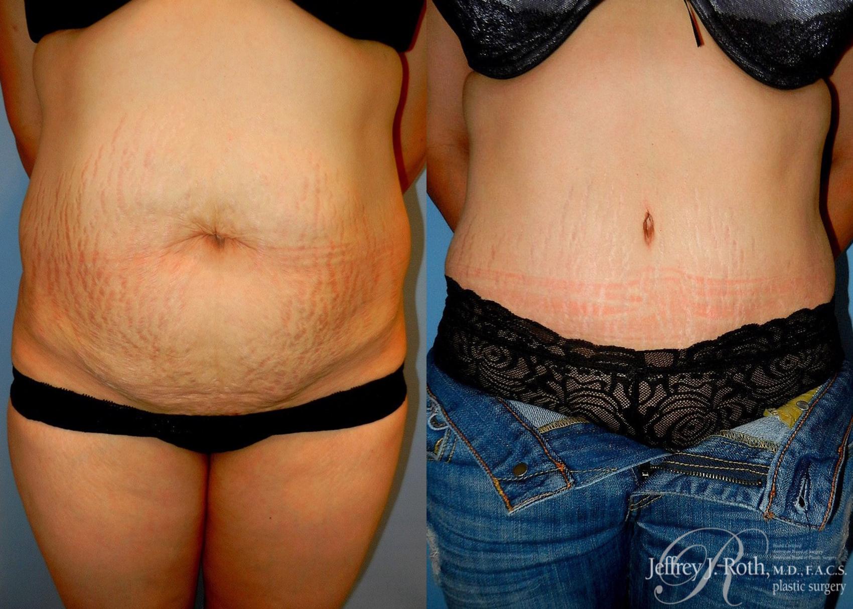Before & After Tummy Tuck Case 24 View #1 View in Las Vegas, NV